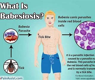 Babesiosis
