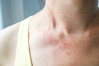 Heat rash